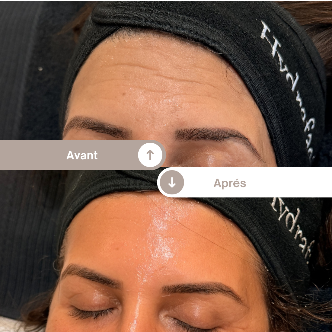 Avant après d’un soin d’épigénétique montrant une amélioration de la texture de peau, de l’éclat et une réduction visible des irrégularités du visage