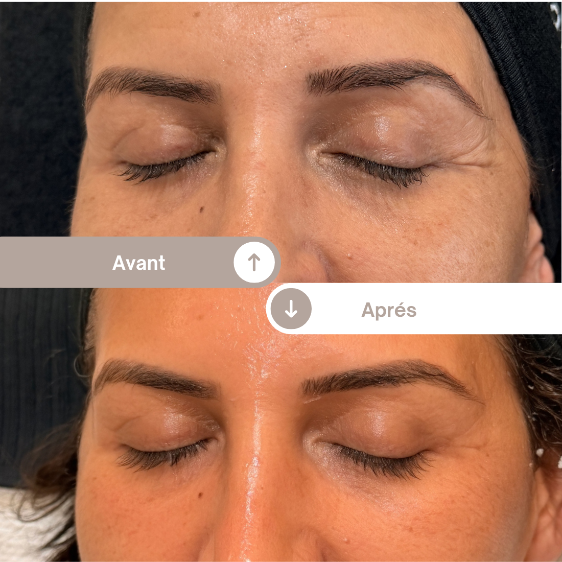 Avant après d’un soin d’épigénétique montrant une amélioration de la texture de peau, de l’éclat et une réduction visible des irrégularités du visage
