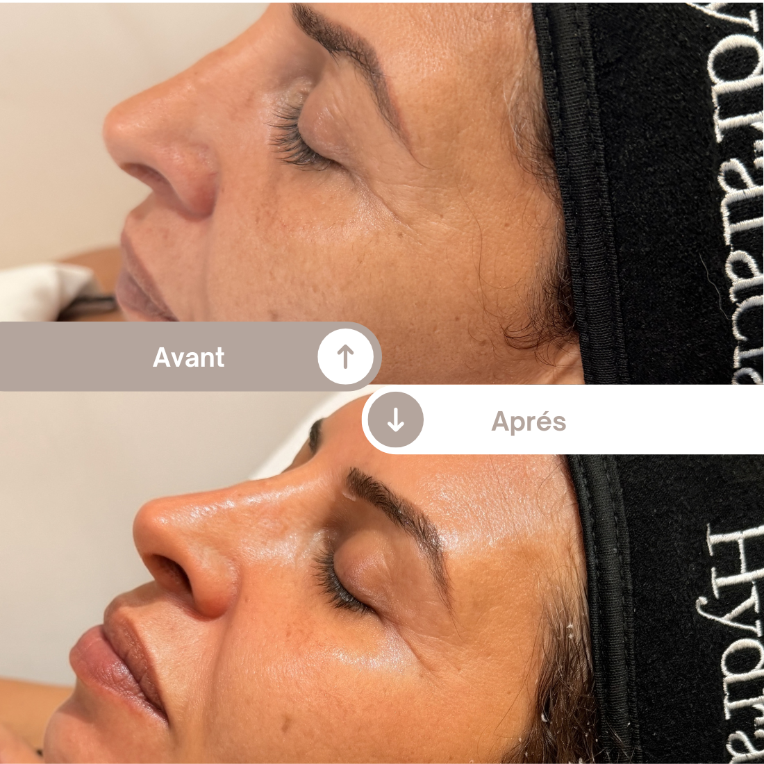 Avant après d’un soin d’épigénétique montrant une amélioration de la texture de peau, de l’éclat et une réduction visible des irrégularités du visage